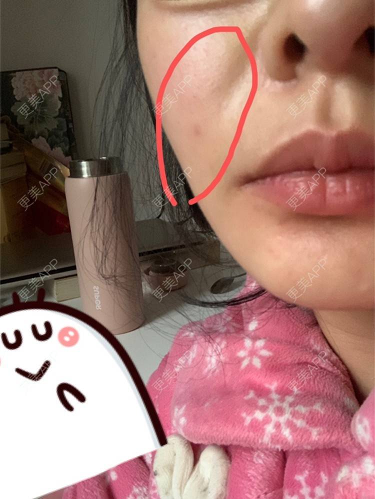 更美 - 皮皮好脾气的除皱瘦脸经验 | 西安 | 注射溶脂瘦脸