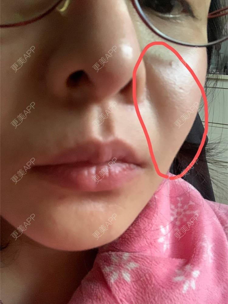 更美 - 皮皮好脾气的除皱瘦脸经验 | 西安 | 注射溶脂瘦脸