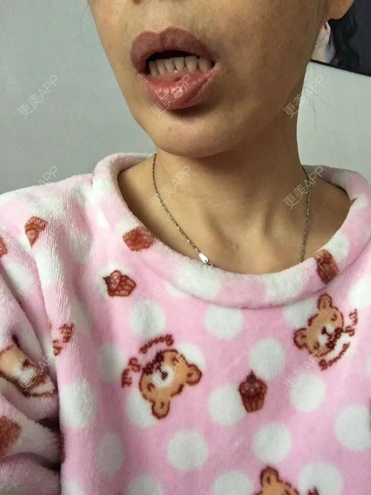 更美 - 更美用户X6u7ZrZMyz的膨体垫下巴经验 | 膨体垫下巴