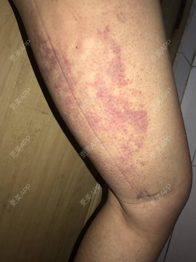 更美 - •你的小可爱•的自体脂肪垫下巴经验 | 自体脂肪垫下巴 | 自体脂肪丰太阳穴 | 深圳 | 自体脂肪垫鼻基底 | 玻尿酸溶解酶