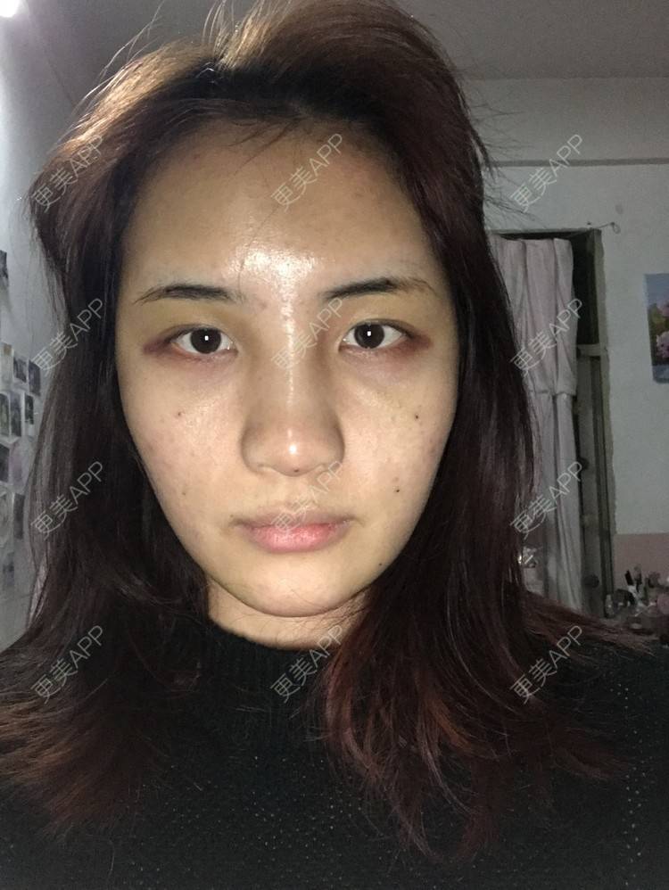 更美 - •你的小可爱•的自体脂肪垫下巴经验 | 自体脂肪垫下巴 | 自体脂肪丰太阳穴 | 深圳 | 自体脂肪垫鼻基底 | 玻尿酸溶解酶