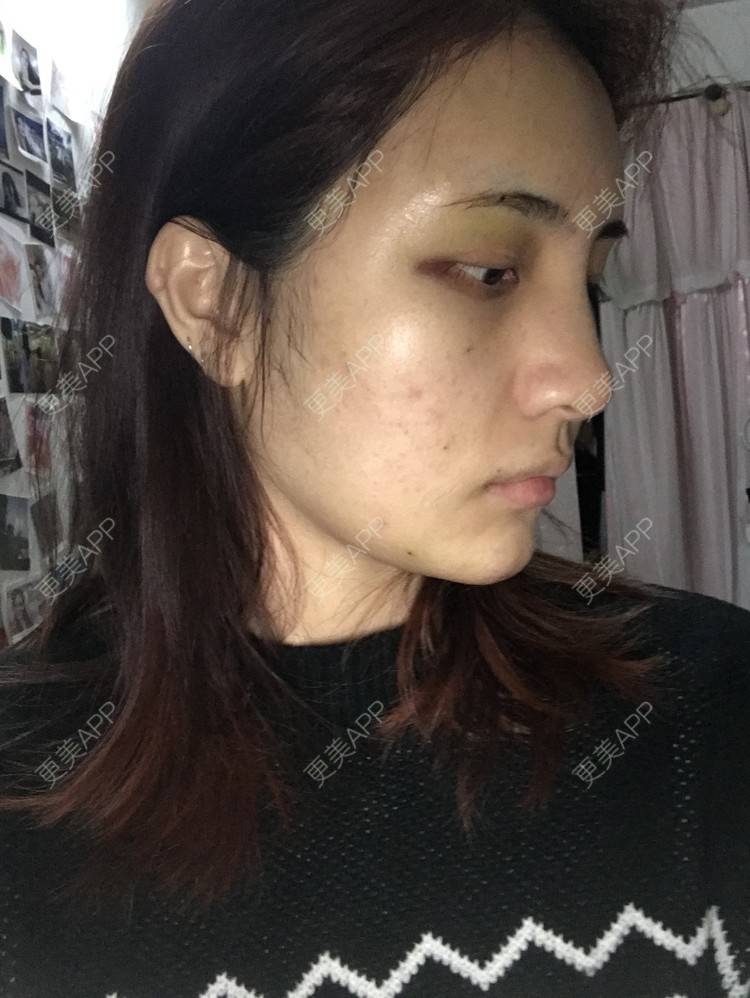 更美 - •你的小可爱•的自体脂肪垫下巴经验 | 自体脂肪垫下巴 | 自体脂肪丰太阳穴 | 深圳 | 自体脂肪垫鼻基底 | 玻尿酸溶解酶