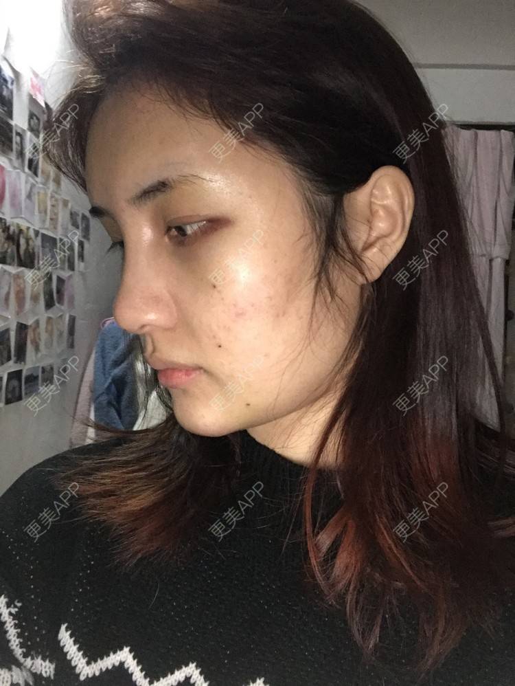 更美 - •你的小可爱•的自体脂肪垫下巴经验 | 自体脂肪垫下巴 | 自体脂肪丰太阳穴 | 深圳 | 自体脂肪垫鼻基底 | 玻尿酸溶解酶