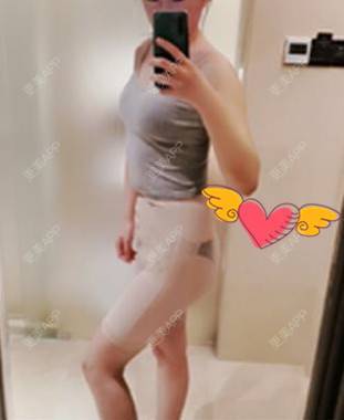 更美 - 更美用户RCdJ1h8KiA的自体脂肪丰臀经验 | 自体脂肪丰臀
