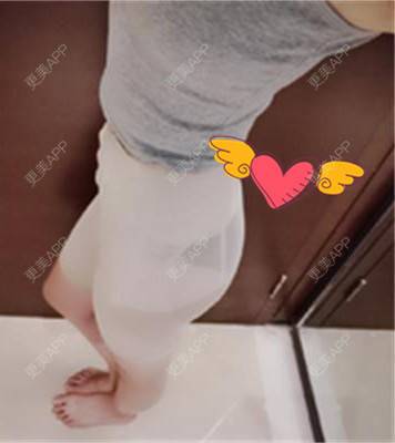 更美 - 更美用户RCdJ1h8KiA的自体脂肪丰臀经验 | 自体脂肪丰臀