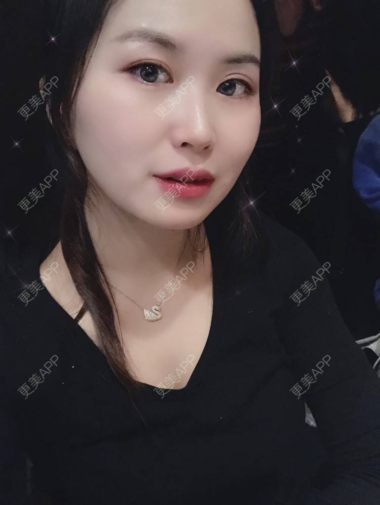 更美 - 更美用户wUmw8hIQ2a的拉皮经验 | 郑州 | 拉皮