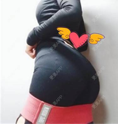 更美 - 更美用户RCdJ1h8KiA的自体脂肪丰臀经验 | 自体脂肪丰臀