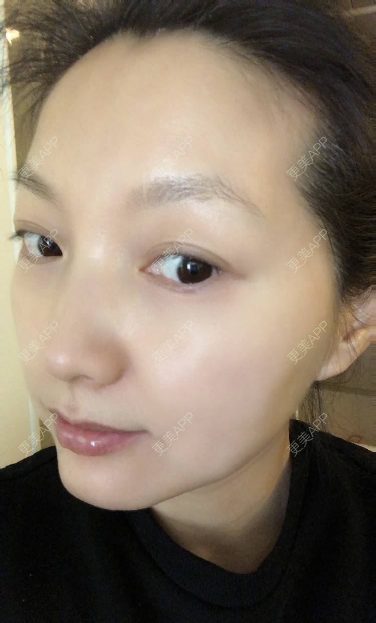 更美 - 更美用户WvfZ2okK9d的微针水光经验 | 微针水光