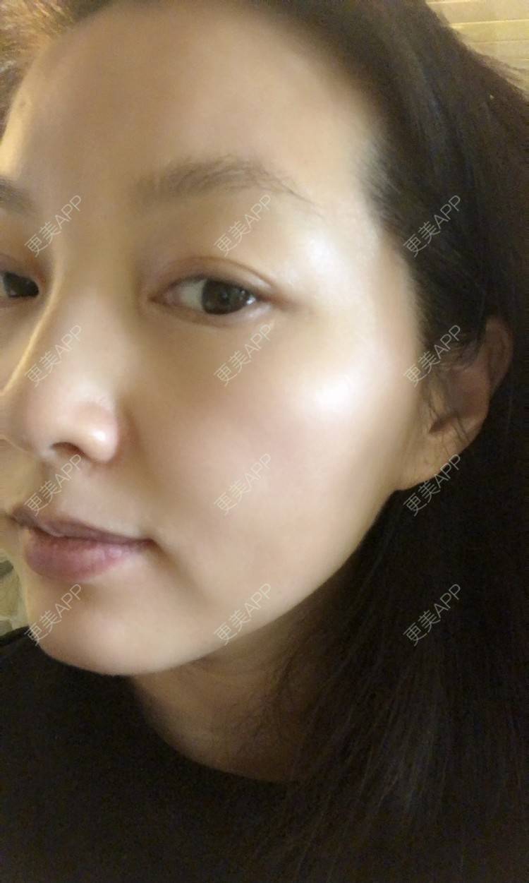 更美 - 更美用户WvfZ2okK9d的微针水光经验 | 微针水光