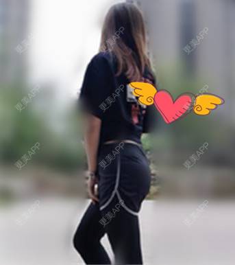更美 - 更美用户RCdJ1h8KiA的自体脂肪丰臀经验 | 自体脂肪丰臀