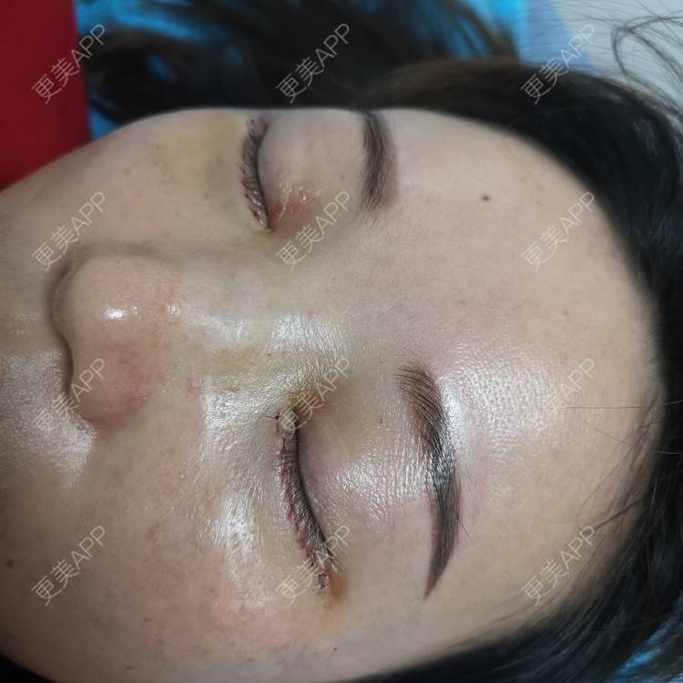 更美 - 更美用户8Z3nsQztj2的综合去眼袋经验 | 外切去眼袋 | 综合去眼袋 | 深圳