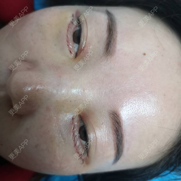 更美 - 更美用户8Z3nsQztj2的综合去眼袋经验 | 外切去眼袋 | 综合去眼袋 | 深圳