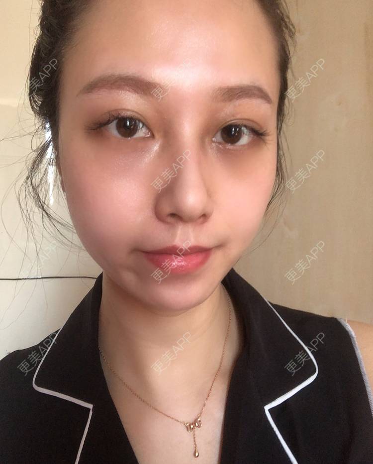 更美 - 祈祷鳄鱼的外切去眼袋经验 | 外切去眼袋 | 眶隔脂肪释放