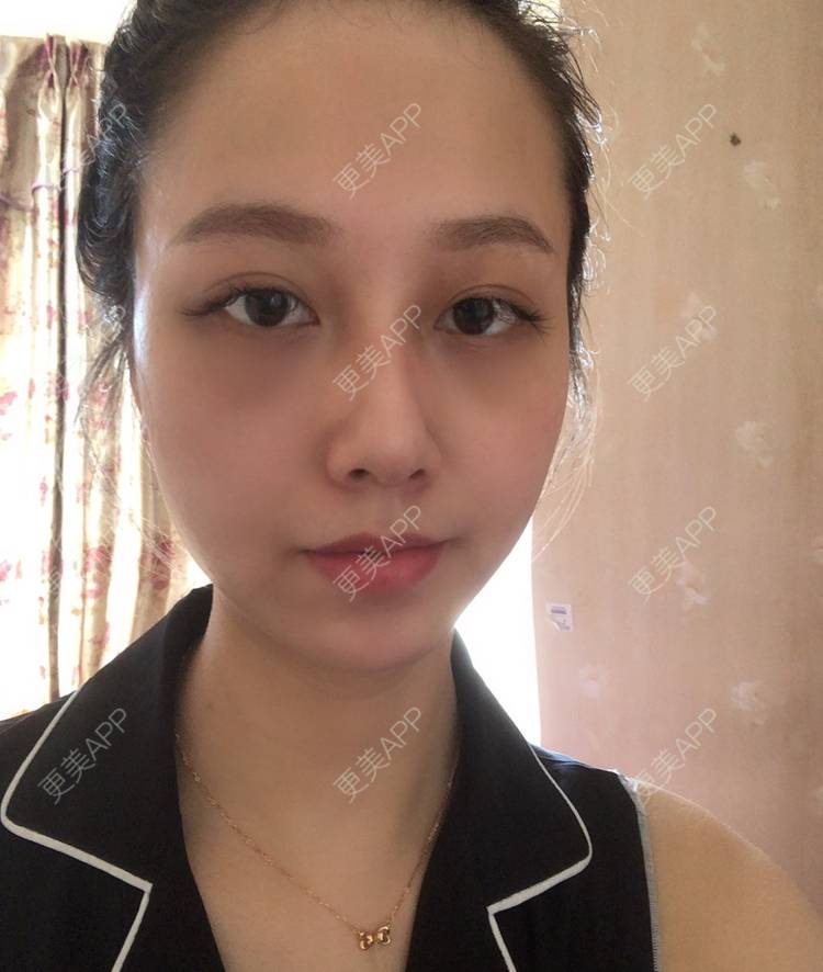更美 - 祈祷鳄鱼的外切去眼袋经验 | 外切去眼袋 | 眶隔脂肪释放