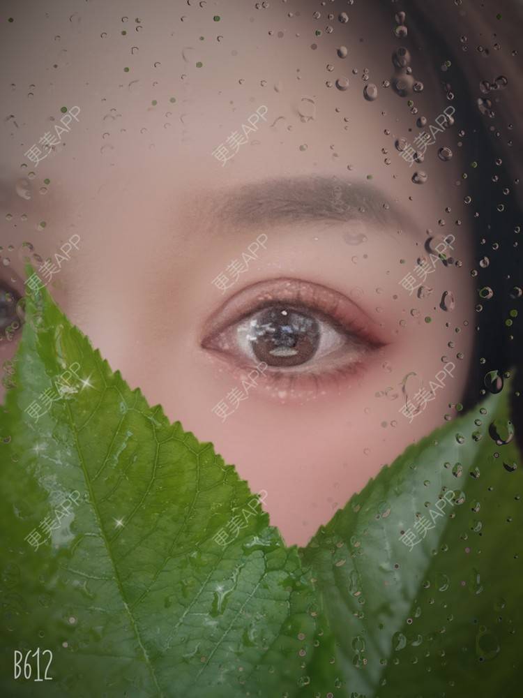 更美 - 更美用户1LMALvMask的双眼皮修复经验 | 双眼皮修复 | 南京