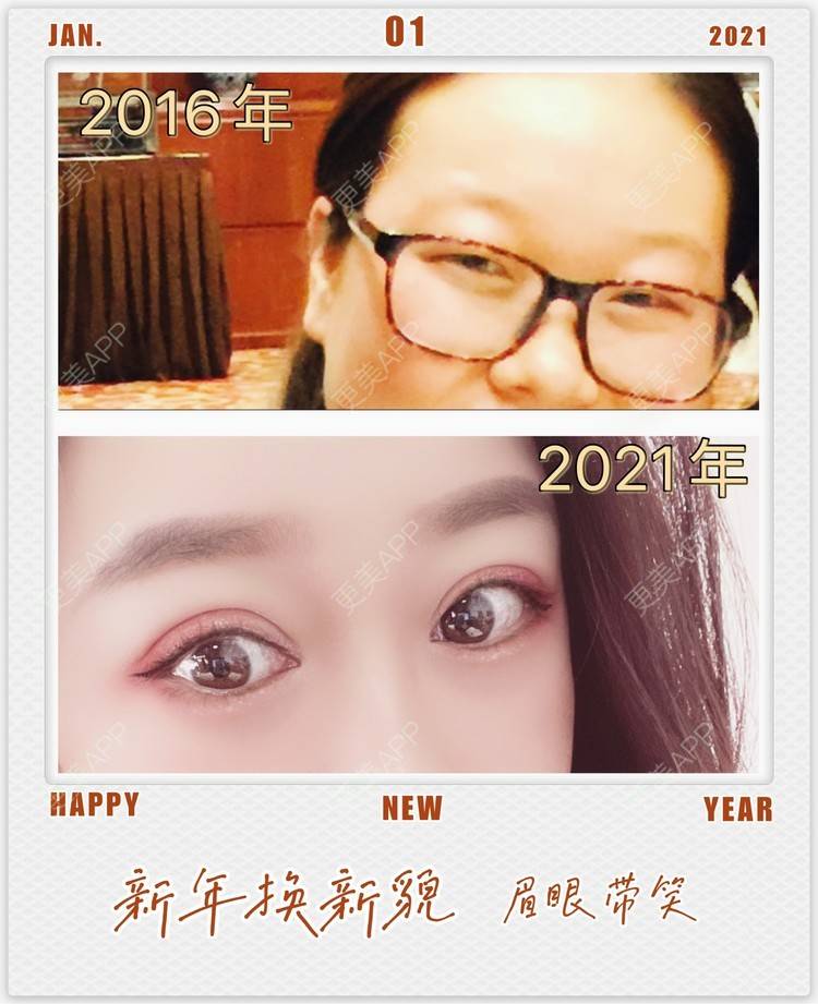 更美 - 更美用户1LMALvMask的双眼皮修复经验 | 双眼皮修复 | 南京