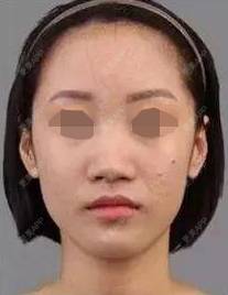 更美 - 更美用户X5GddFZ3dZ的玻尿酸鼻部经验 | 玻尿酸鼻部
