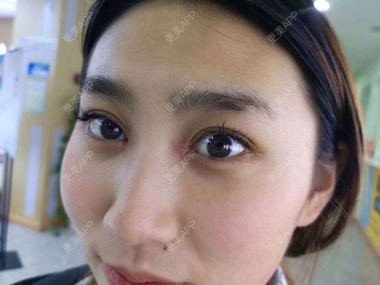 更美 - 更美用户LK67zZ3Pio的定点双眼皮经验 | 深圳 | 定点双眼皮