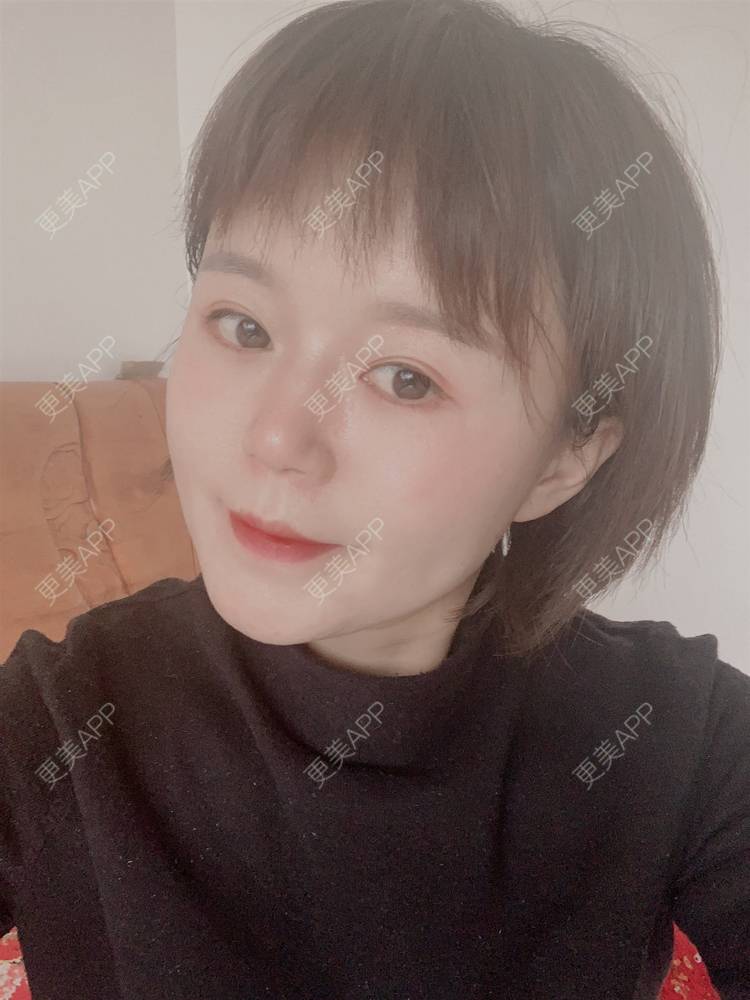 更美 - 乘风破浪小美眉的开外眼角经验 | 开外眼角 | 重庆 | 提眉修复