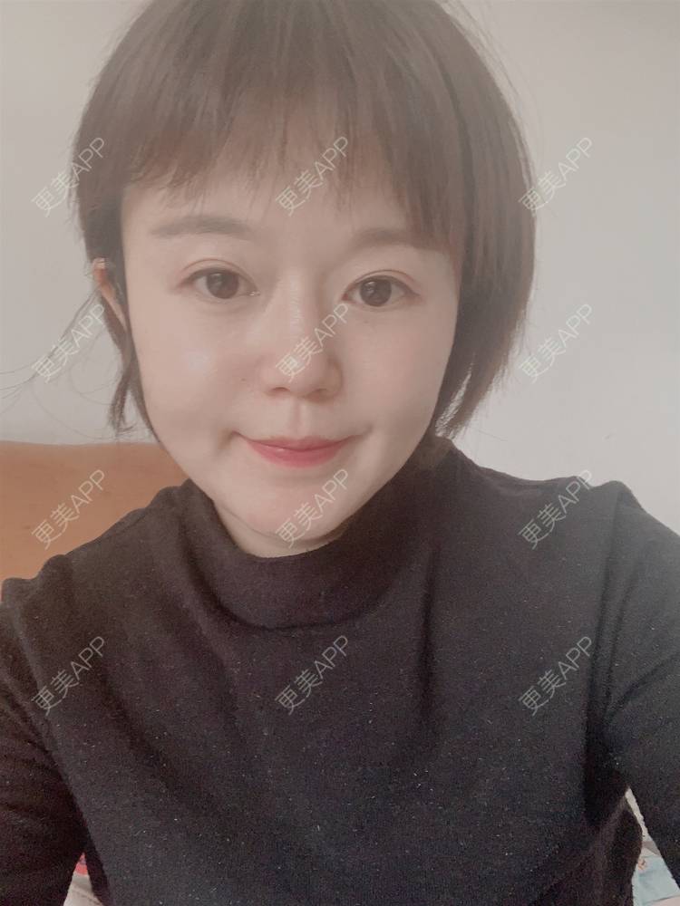 更美 - 乘风破浪小美眉的开外眼角经验 | 开外眼角 | 重庆 | 提眉修复