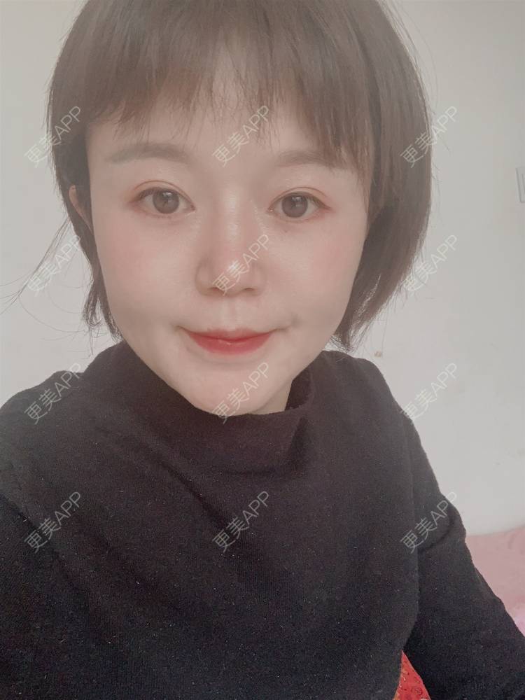 更美 - 乘风破浪小美眉的开外眼角经验 | 开外眼角 | 重庆 | 提眉修复