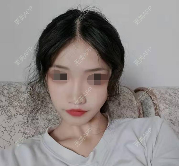 更美 - 更美用户XpYzjiudCc的玻尿酸鼻部经验 | 玻尿酸鼻部