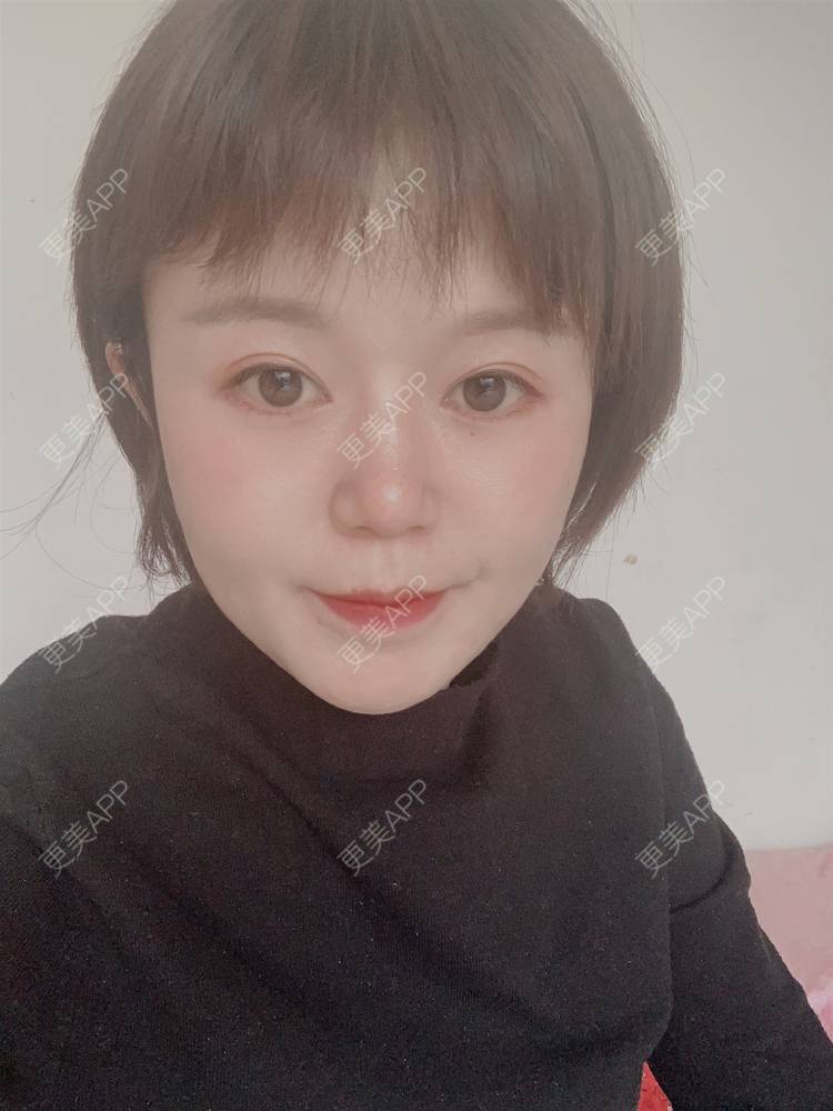 更美 - 乘风破浪小美眉的开外眼角经验 | 开外眼角 | 重庆 | 提眉修复
