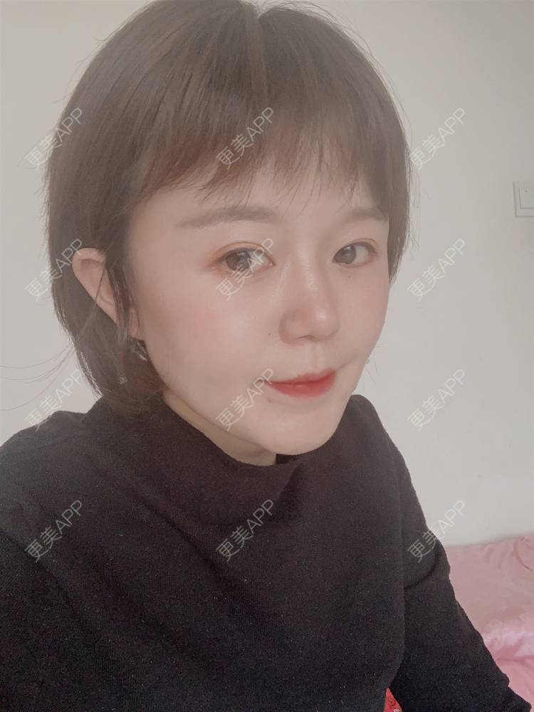 更美 - 乘风破浪小美眉的开外眼角经验 | 开外眼角 | 重庆 | 提眉修复