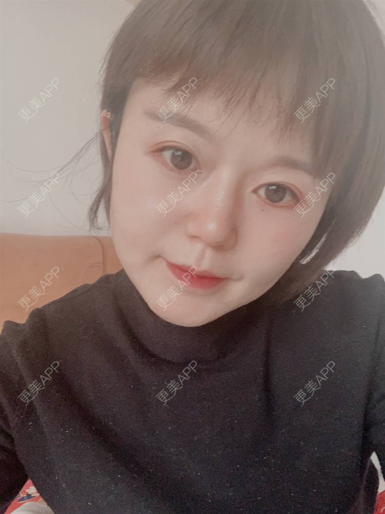 更美 - 乘风破浪小美眉的开外眼角经验 | 开外眼角 | 重庆 | 提眉修复