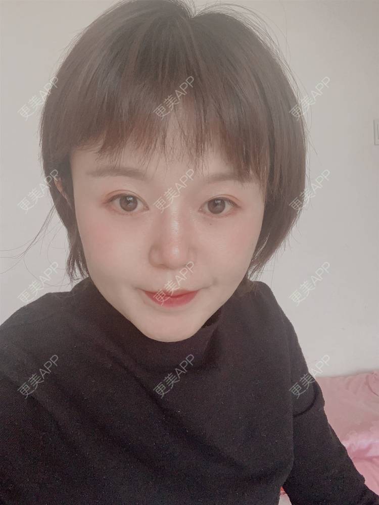 更美 - 乘风破浪小美眉的开外眼角经验 | 开外眼角 | 重庆 | 提眉修复
