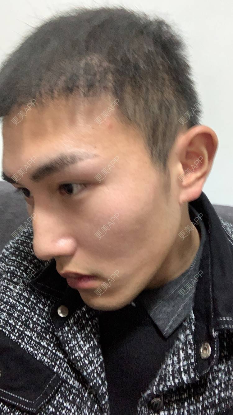 更美 - D调··的植发际线经验 | 植发际线 | 成都