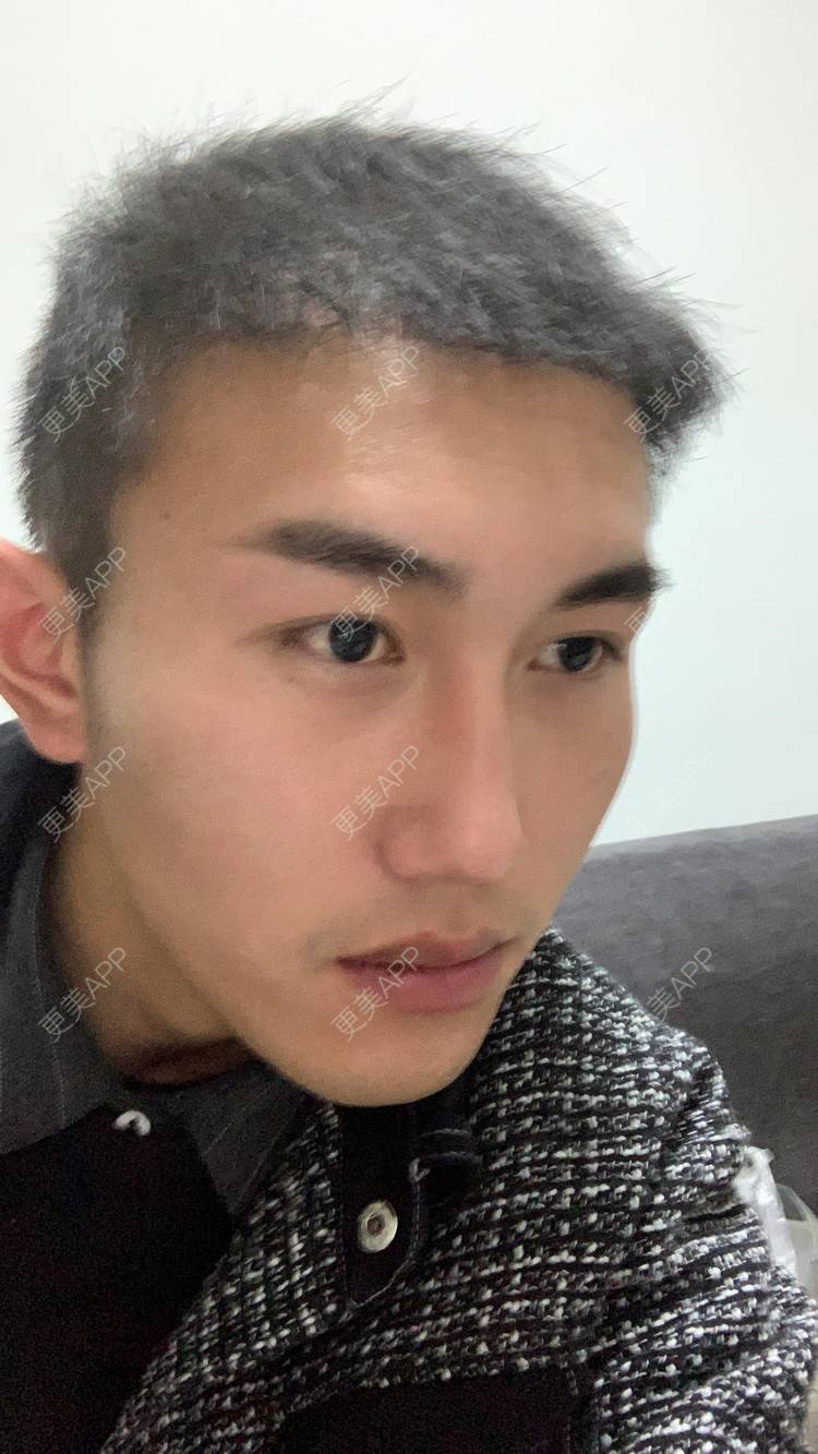 更美 - D调··的植发际线经验 | 植发际线 | 成都