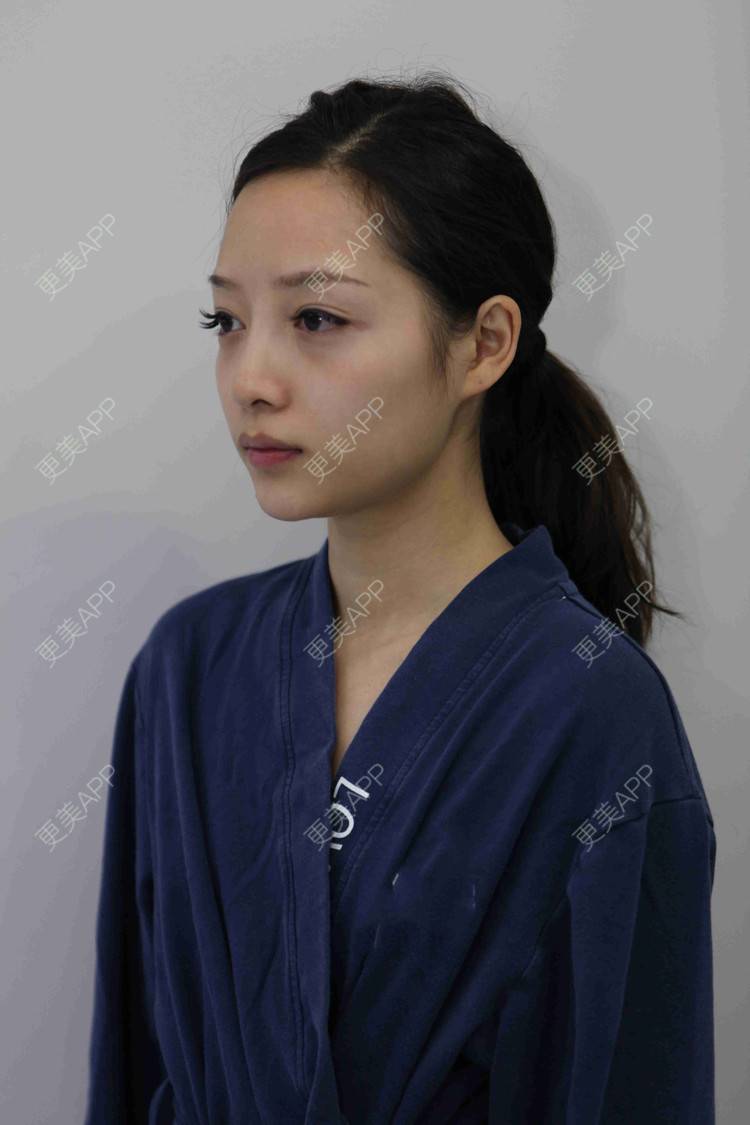 更美 - 佳人人家的鼻部多项经验 | 视频日记 | 鼻部多项 | 重庆