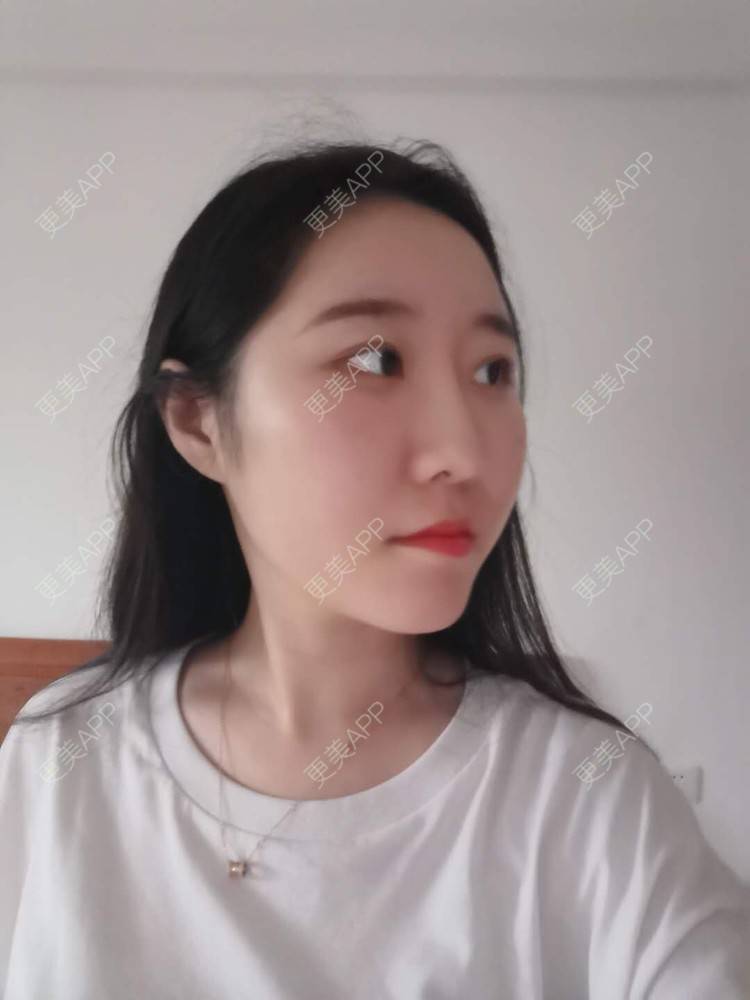更美 - 更美用户1hiCD9ueO6的颧骨内推经验 | 颧骨内推 | 广州