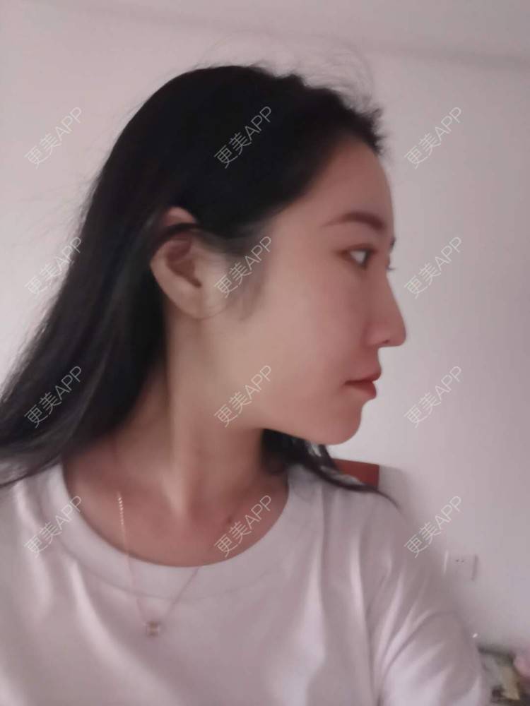 更美 - 更美用户1hiCD9ueO6的颧骨内推经验 | 颧骨内推 | 广州