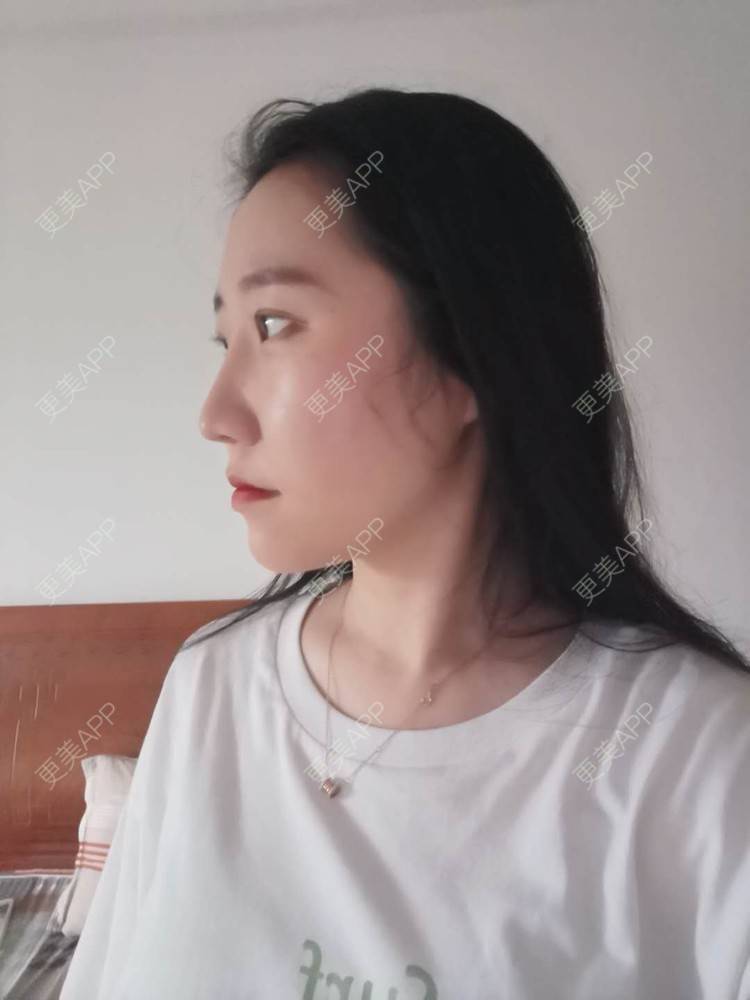 更美 - 更美用户1hiCD9ueO6的颧骨内推经验 | 颧骨内推 | 广州