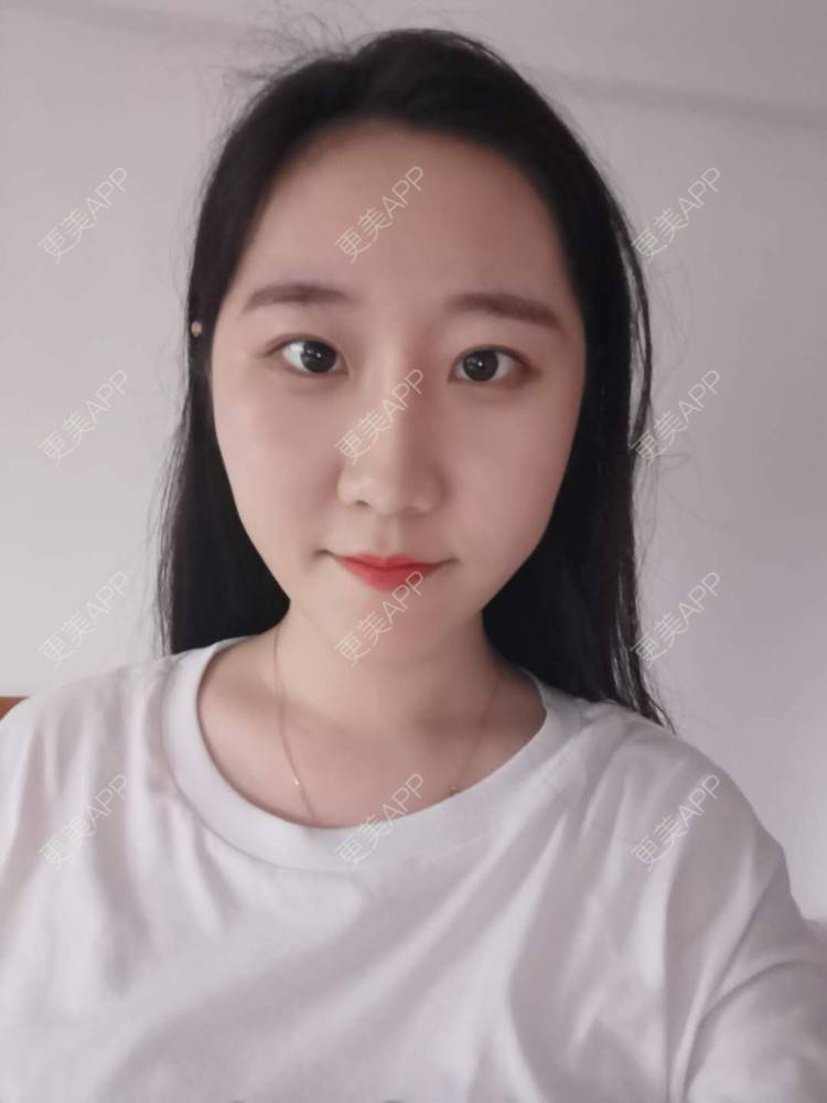 更美 - 更美用户1hiCD9ueO6的颧骨内推经验 | 颧骨内推 | 广州
