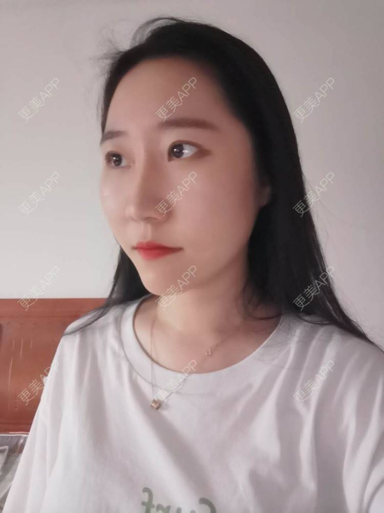更美 - 更美用户1hiCD9ueO6的颧骨内推经验 | 颧骨内推 | 广州
