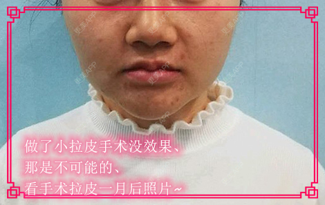 更美 - kris味苮女廖的拉皮经验 | 北京 | 拉皮