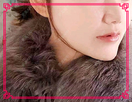 更美 - kris味苮女廖的拉皮经验 | 北京 | 拉皮