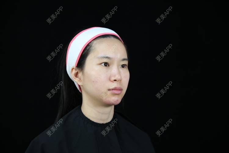 更美 - 孤影不多就我一个鹿的玻尿酸下巴经验 | 北京 | 玻尿酸下巴