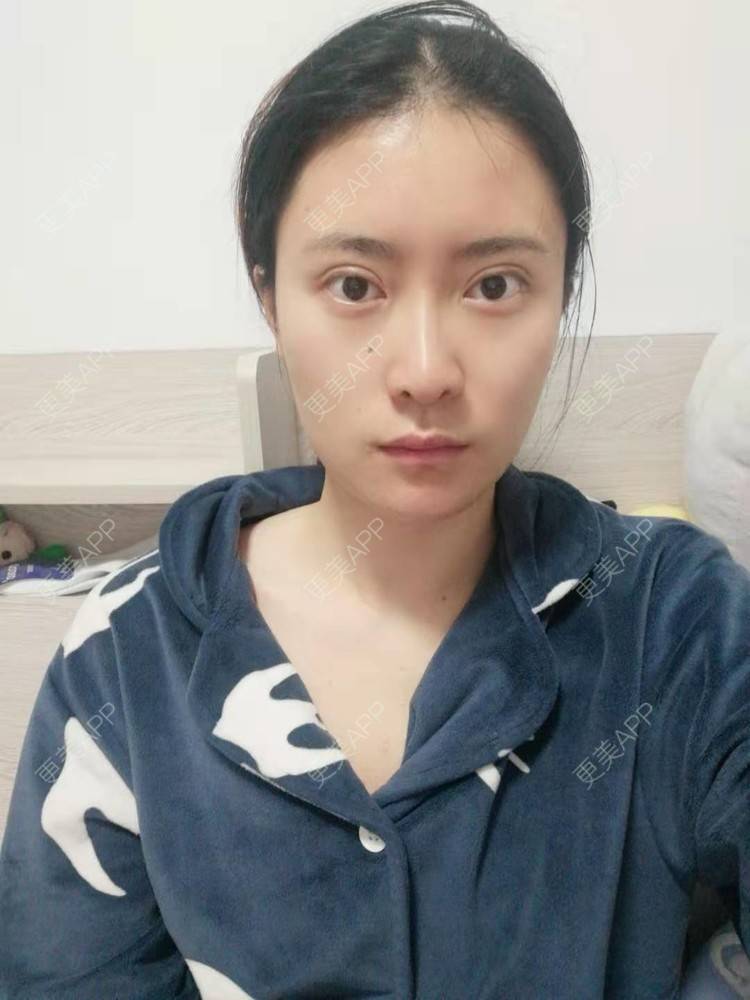 更美 - 更美用户amaVQcpH2K的全脸整形套餐经验 | 成都 | 全脸整形套餐