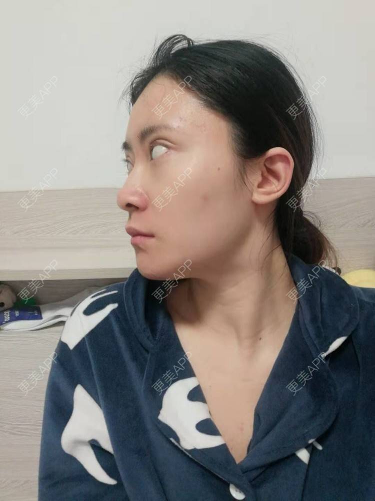 更美 - 更美用户amaVQcpH2K的全脸整形套餐经验 | 成都 | 全脸整形套餐