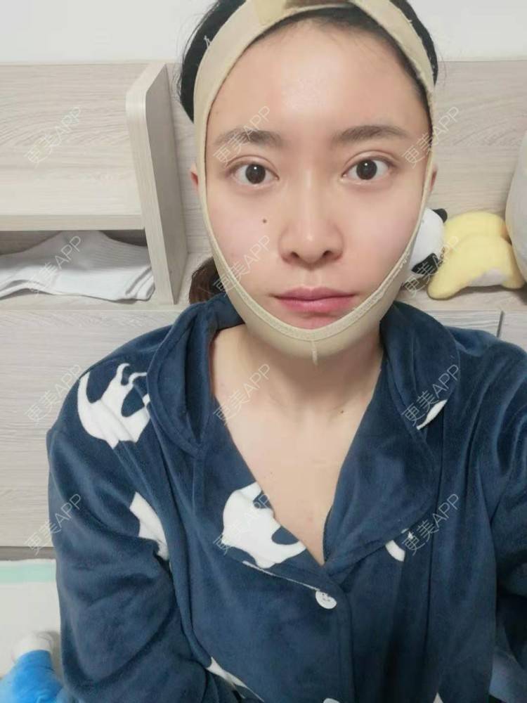 更美 - 更美用户amaVQcpH2K的全脸整形套餐经验 | 成都 | 全脸整形套餐