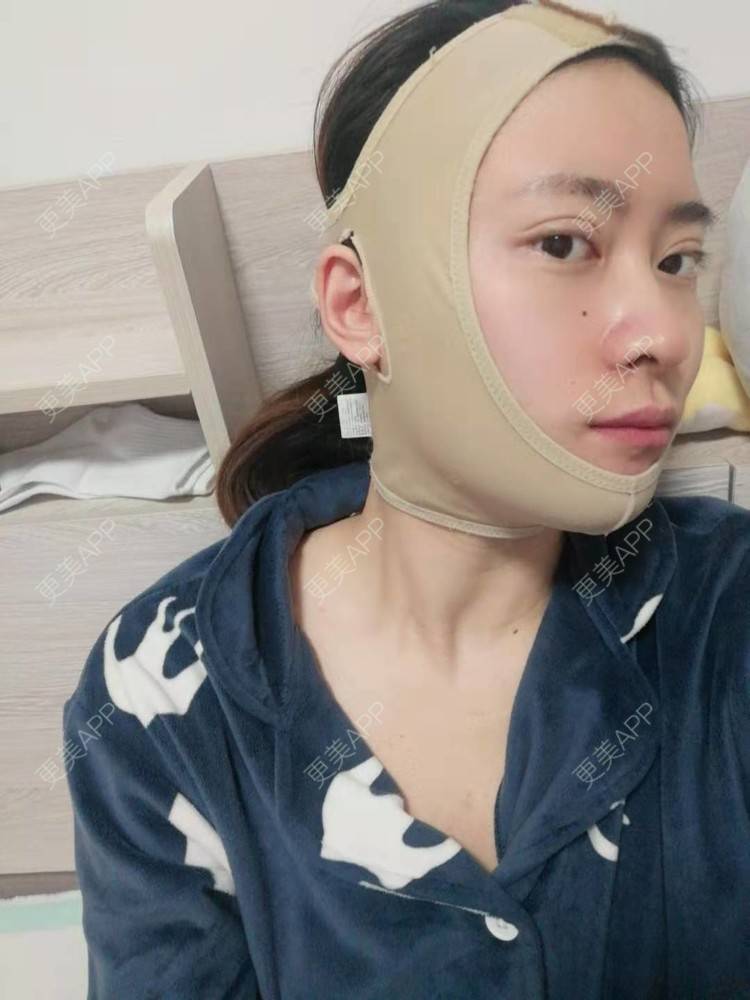 更美 - 更美用户amaVQcpH2K的全脸整形套餐经验 | 成都 | 全脸整形套餐