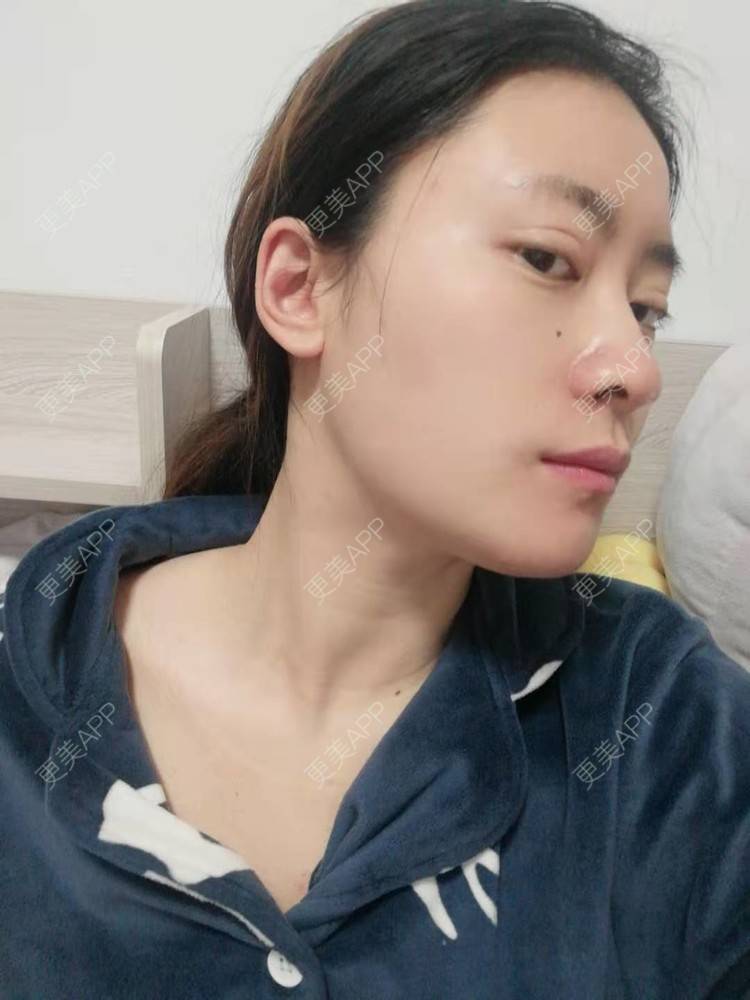 更美 - 更美用户amaVQcpH2K的全脸整形套餐经验 | 成都 | 全脸整形套餐