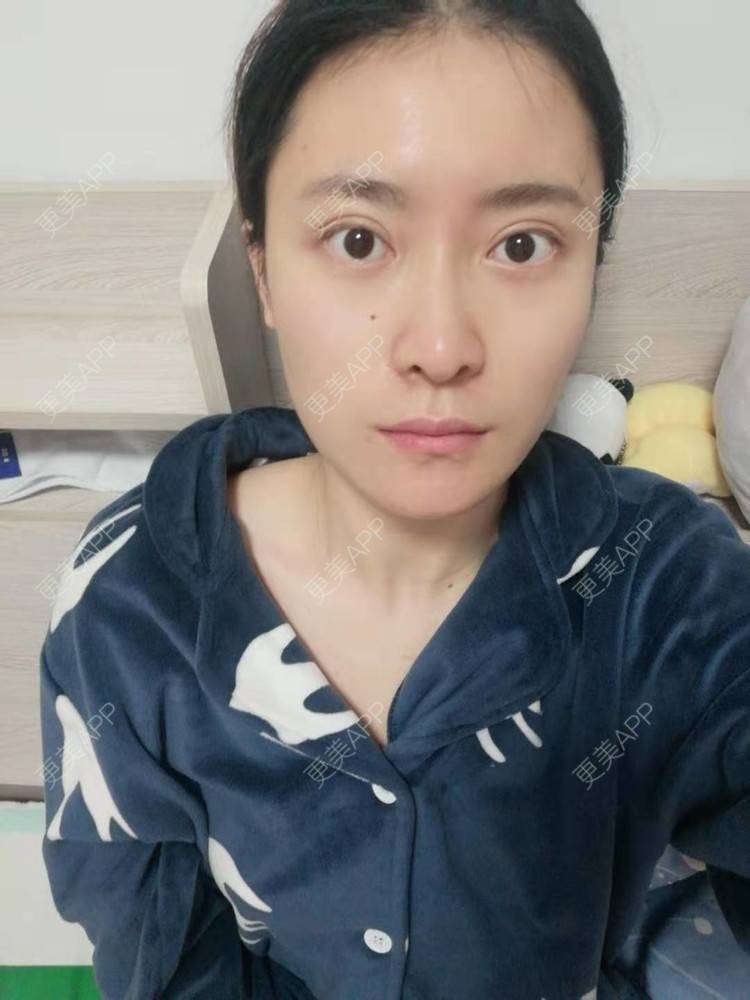 更美 - 更美用户amaVQcpH2K的全脸整形套餐经验 | 成都 | 全脸整形套餐