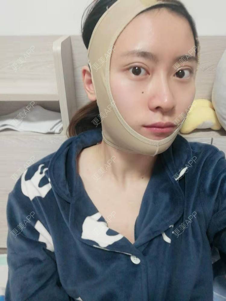 更美 - 更美用户amaVQcpH2K的全脸整形套餐经验 | 成都 | 全脸整形套餐