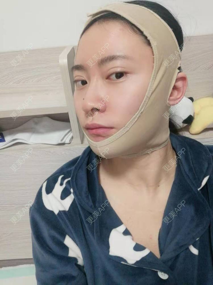 更美 - 更美用户amaVQcpH2K的全脸整形套餐经验 | 成都 | 全脸整形套餐