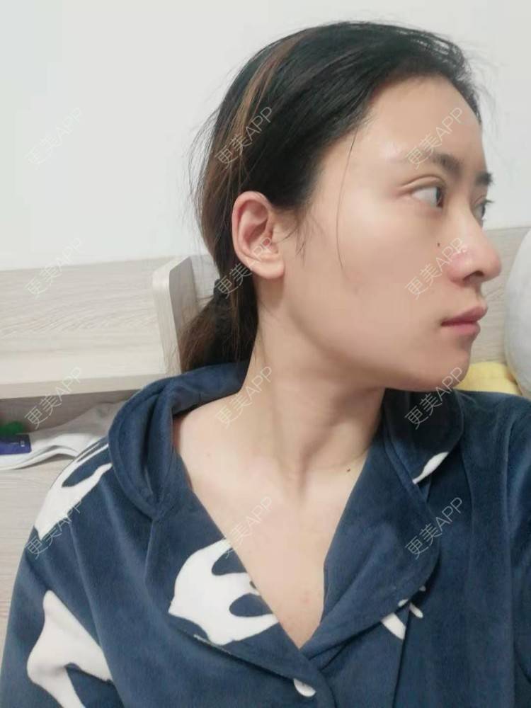 更美 - 更美用户amaVQcpH2K的全脸整形套餐经验 | 成都 | 全脸整形套餐